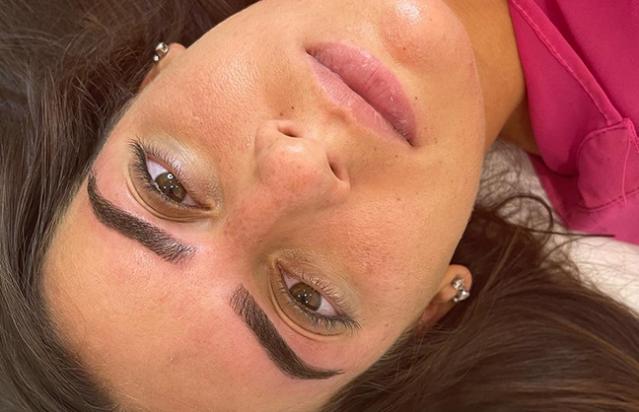 épilation du visage au laser